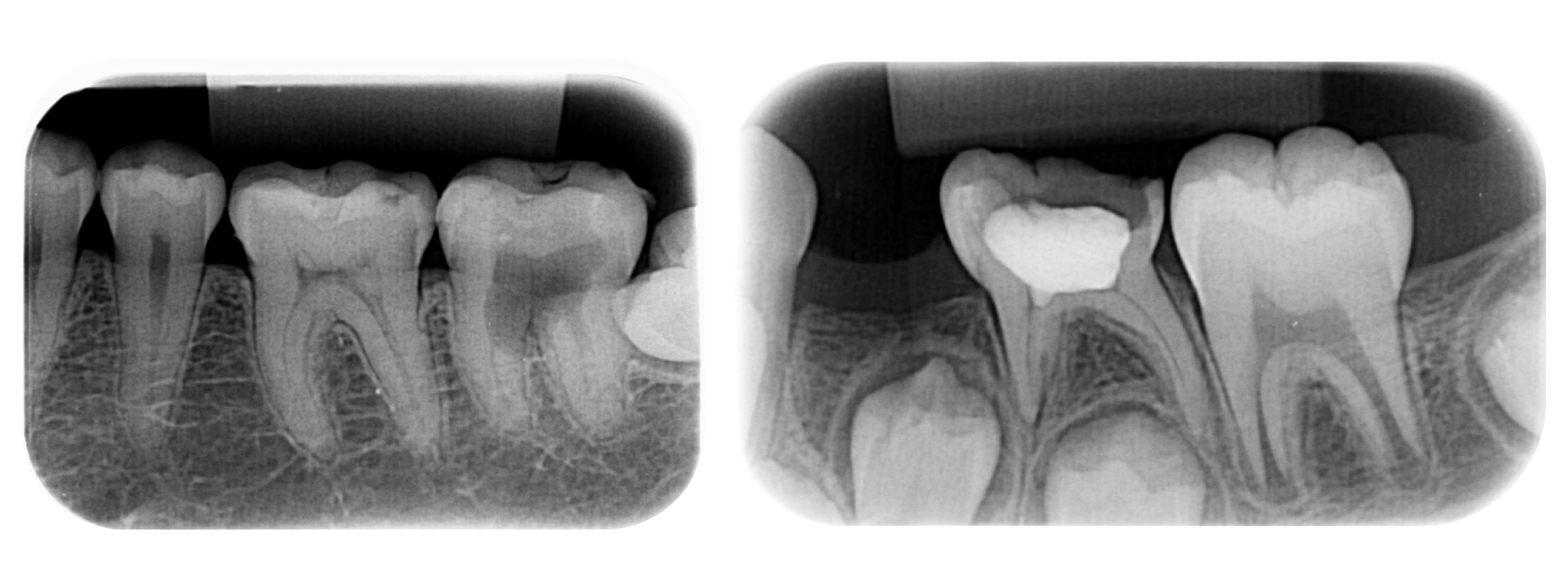 Radiografía Intrabucal